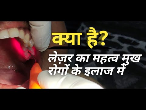 Laser Treatment For Oral Diseases
