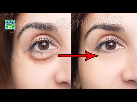 How to get rid of UNDER EYE BAGS FAST (the SAFEST ways)