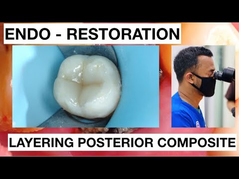 Odbudowa warstwowa kompozytowa zęba po leczeniu endodontycznym - krok po kroku