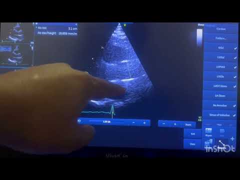 How to perform standard echo measurements
