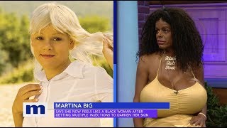 White woman gets chemical skin injections to turn her skin dark, now claims she is a black woman. [