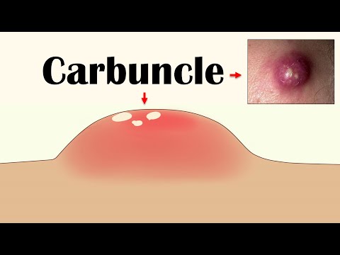 Carbuncle - Causes, Signs & Symptoms, Risk Factors, Diagnosis, & Treatment