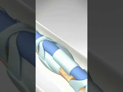 Trigger Finger Condition and Release 3D Animation No Narration