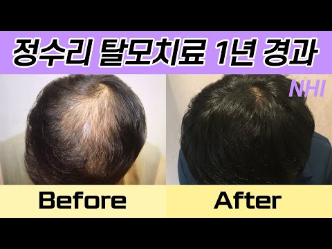 정수리탈모치료 정수리모발개선 360일 경과 I 뉴헤어 I Before&After [탈모치료][모발이식]