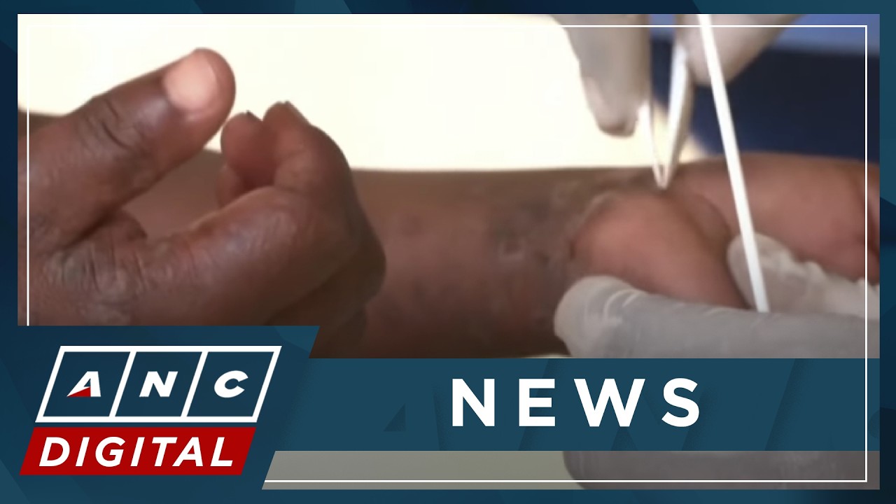 WHO calls for ramped-up mpox vaccine production | ANC