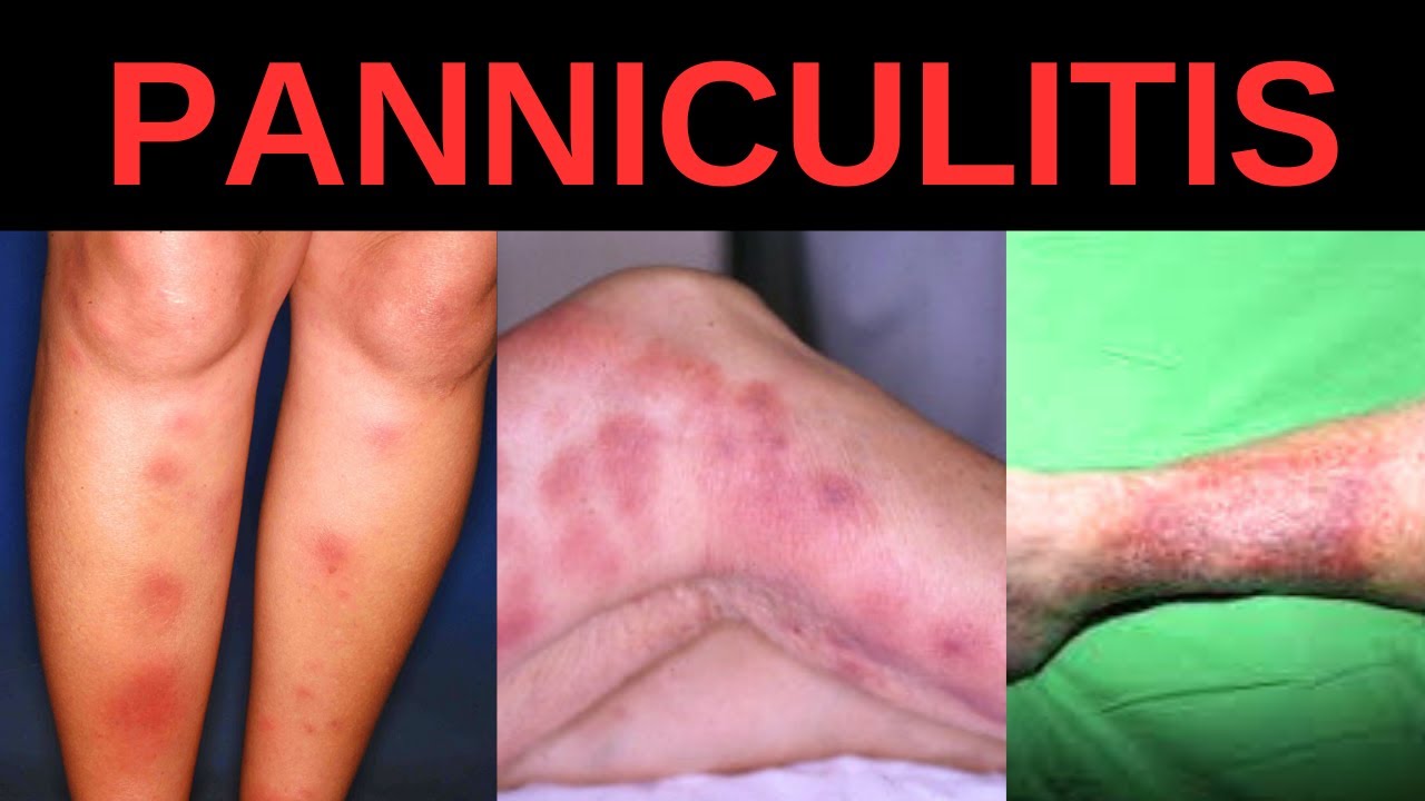 Panniculitis Types Causes And Treatment