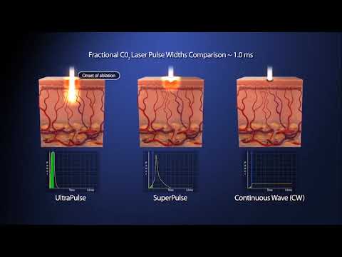 Power of the Pulse - AcuPulse and UltraPulse | Lumenis