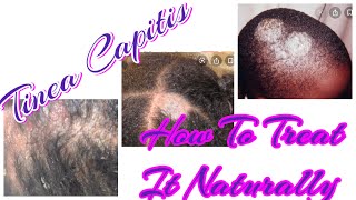 Tinea Capitis: How To Treat It Naturally (Diagnosed/update/treatment)