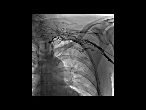 Left Upper Extremity Venogram of Thrombosis of Left Subclavian Vein With Network of Small Veins