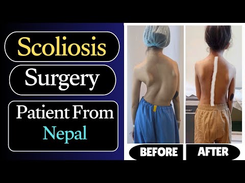 idiopathic scoliosis video