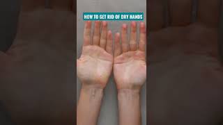 How to ged rid of dry hands