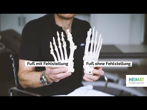 Hallux Valgus - die Fußfehlstellung in den Griff bekommen!