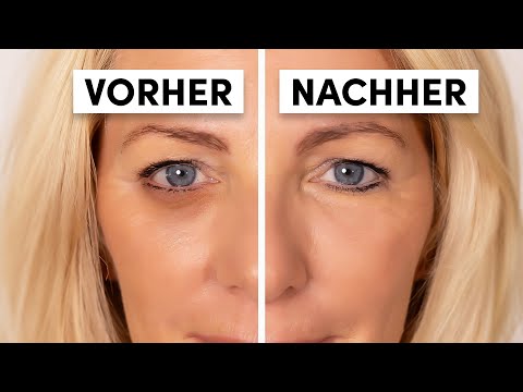 Wieder natürlich strahlen: Ursache von dunklen Augenringen beheben