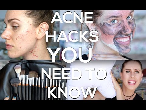 ACNE HACKS YOU NEED TO KNOW! Video