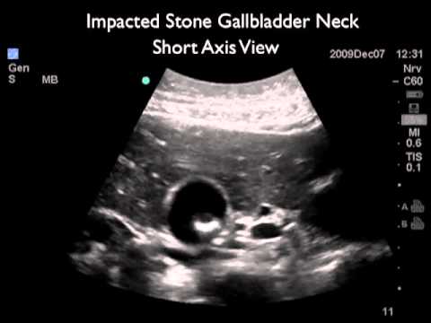 How To: Gallbladder Ultrasound Part 2 - Gallstones Case Study Video