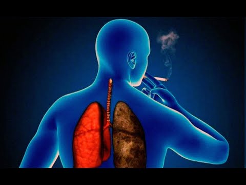 La EPOC es una enfermedad irreversible que se puede prevenir