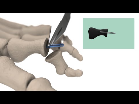 Hammertoe correction using bioabsorbable Inion FreedomPin™