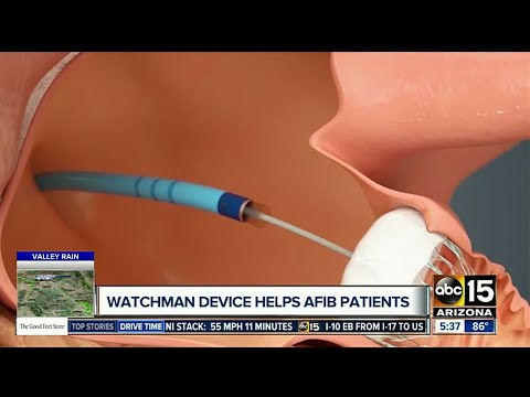 Watchman Device: Quarter-sized device helps reduce stroke risk for atrial fibrillation patients
