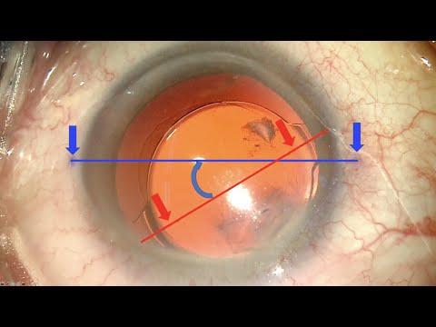 Recolocación de lente intraocular tórica (de astigmatismo) rotada