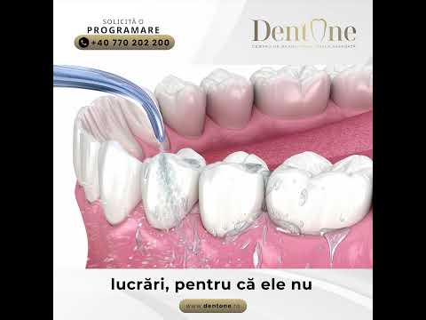 Cum îngrijești corect implanturile dentare?