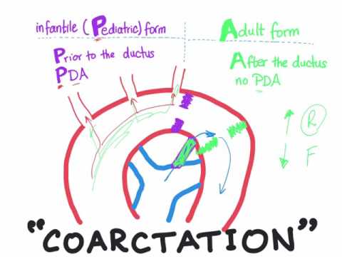 Coarctation of aorta (Infantile type vs adult type) mnemonic