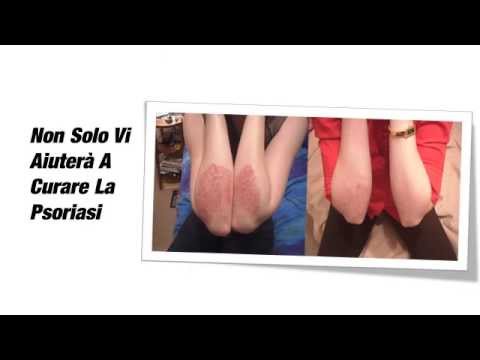 Bambini di eczema di asma Crema emolium allatto di risposte di dermatite atopic