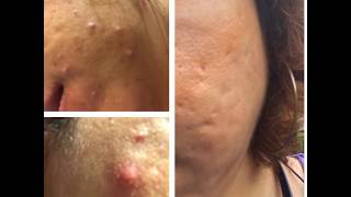 Acne/Wrinkles/Skin Tightening at Panacea Massage & Spa Houston TX