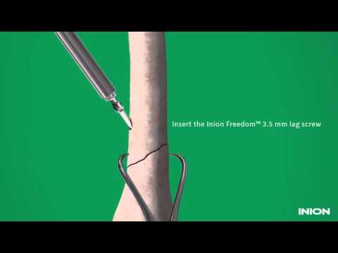 Inion Freedom™ Drill Tap