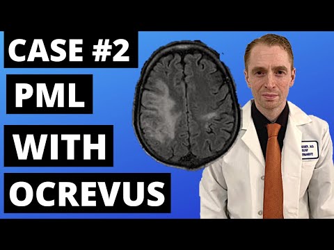 2nd PML Case With Ocrevus Reported by Genentech