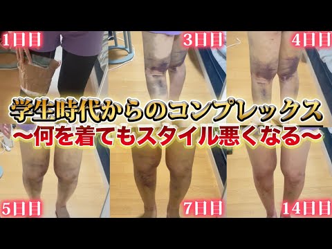 何を着てもスタイル崩壊…学生時代からの脚コンプレックスに終止符を！脂肪吸引レポート公開