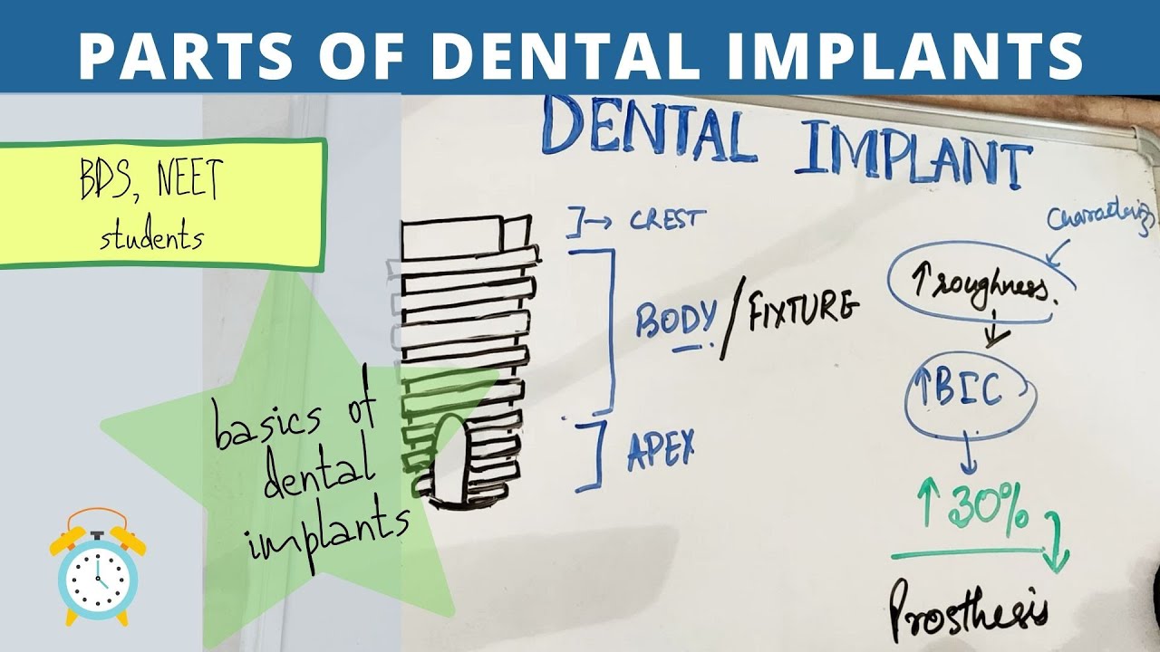 Watch basics of dental implants - parts of implant Now basics of dental implants - parts of implant