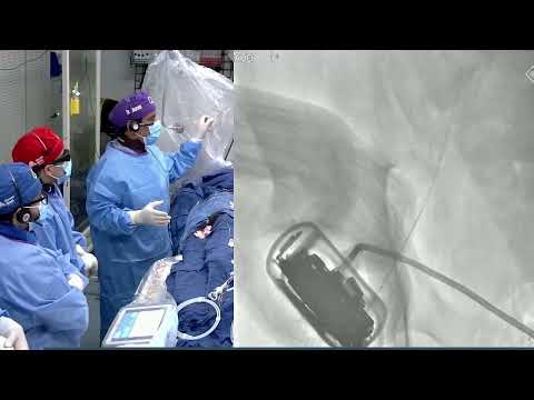 Live Case 2 - Impella Supported PCI of Calcified LAD & LCx using RA & OCT Guidance