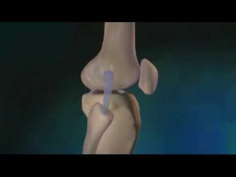 Rupture du ligament croisé antérieur - Dr Philippe Loriaut