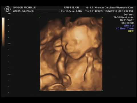 Michelle's 20 Week Ultrasound