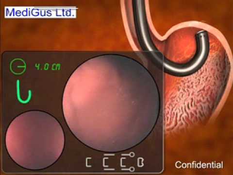 MediGus innovative endoscopy system for the treatment of GERD logo