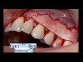 Treatment of Gum Recession with Alloderm.