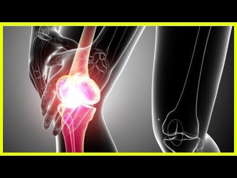 Arthrose des Kniegelenks Übungen Methode Dr. Popov Verwendung von Glucosamin in Osteochondrose