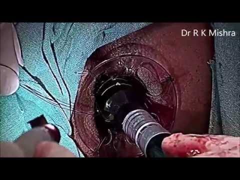 Hemorrhoids Frequently asked question