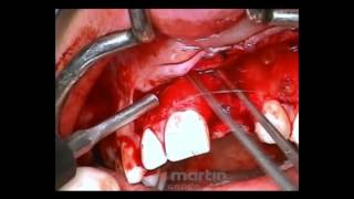 SonicWeld Rx® Dental | Shell technique