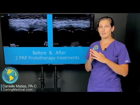 PRP Prolotherapy for pelvic pain & pubic symphysis injury & ultrasound as an objective measurement