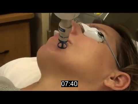 Skin Resurfacing - ClearLift Full Face in Under Ten Minutes