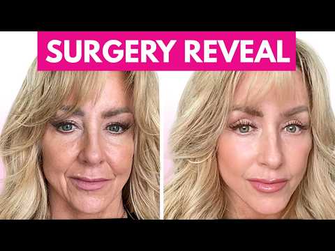 Why I Got A Facelift (And Why I’m Not Sorry!)