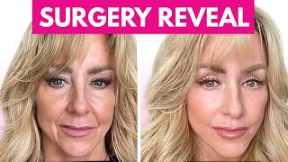 Why I Got A Facelift (And Why I’m Not Sorry!)
