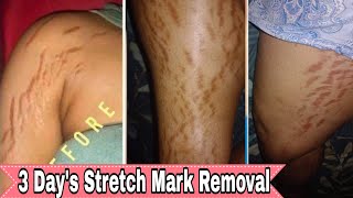 stretch mark removal / how to remove stretch mark using baking soda & lemon get rid of stretch marks