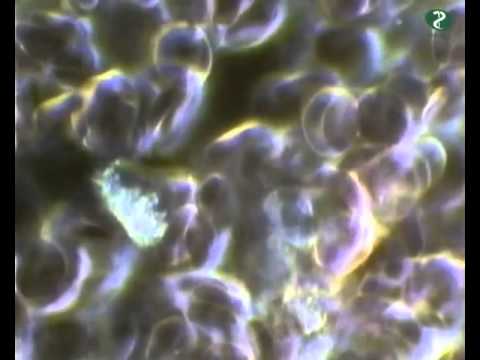 Positive Beeinflussung des Blutes durch SANZA Kombinationstherapie