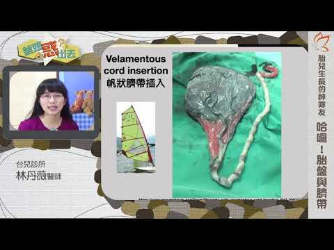 帆狀胎盤