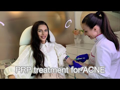 PRP treatment for acne | Skinfinity | ПРП третман за акни | Zoi Blaz