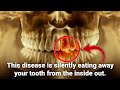 Science Of Tooth Decay HealthSpark