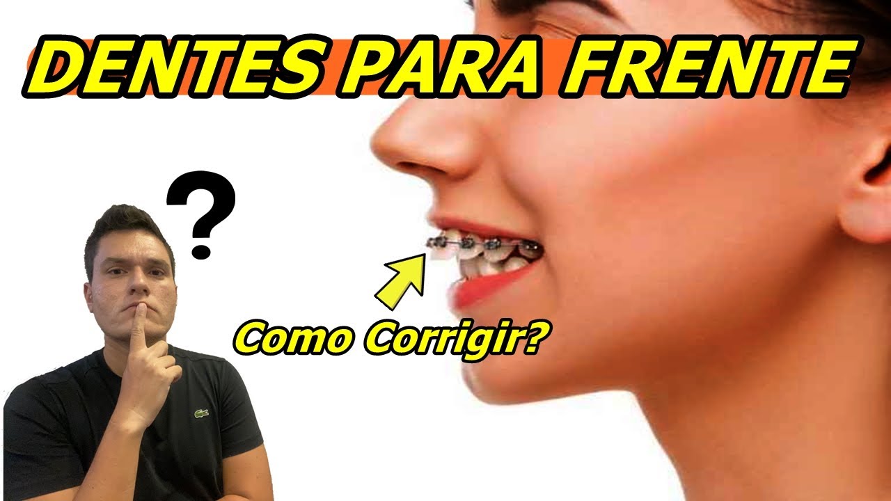 DENTES MUITO PARA FRENTE | VEJA SE CORRIGE COM APARELHO!