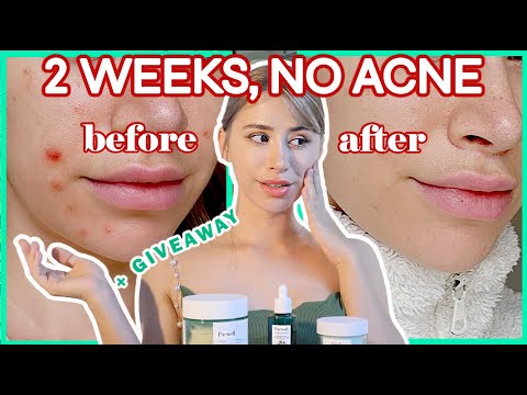 💦 CLEARED MY ACNE IN 2 WEEKS WITH A HONEY SKINCARE ROUTINE! 💥 Parnell Beauty skincare